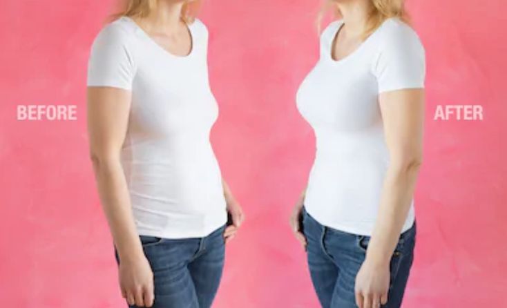 عملية شفط وشد البطن.. استعيدي قوامكِ المثالي بلمسة سحرية وتقنيات عالمية