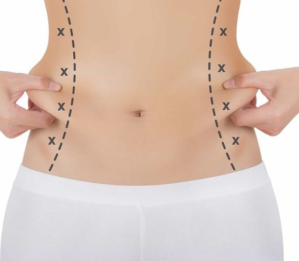 شفط الدهون وشد الترهلات.. دليلكِ الشامل لنحت الجسم واستعادة القوام المثالي في عيادة الرحيمي