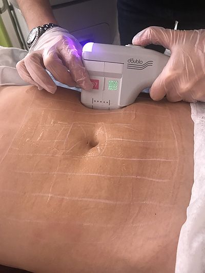 عملية تصغير الصدر - استعيدي خفة جسمك في عيادة الرحيمي