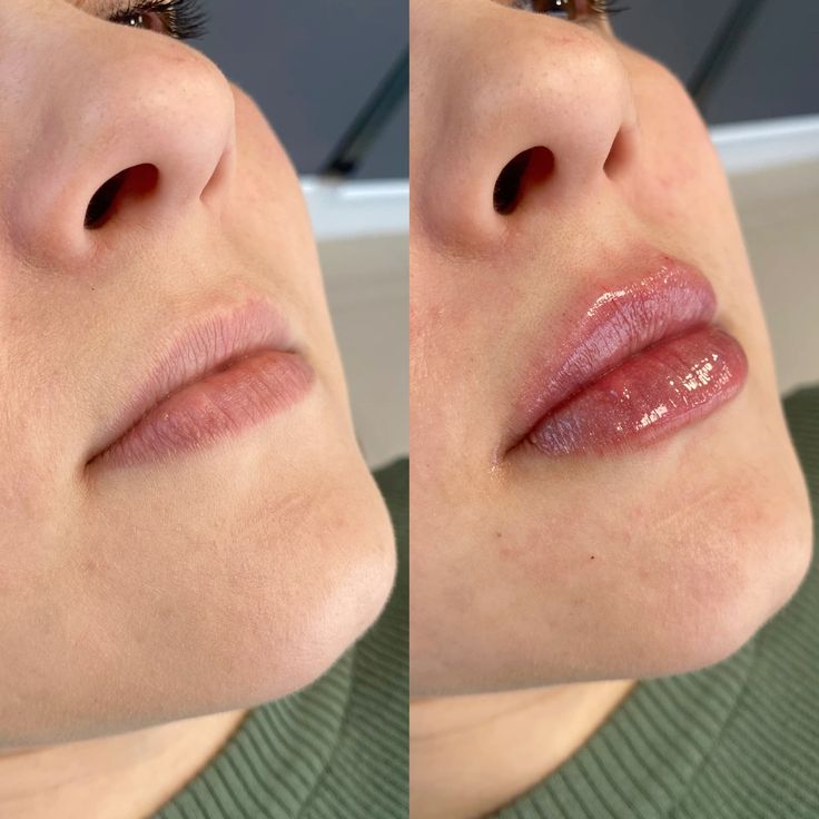 دليلك الشامل حول سعر الفيلر للشفايف في الخبر بمستشفى الرحيمي